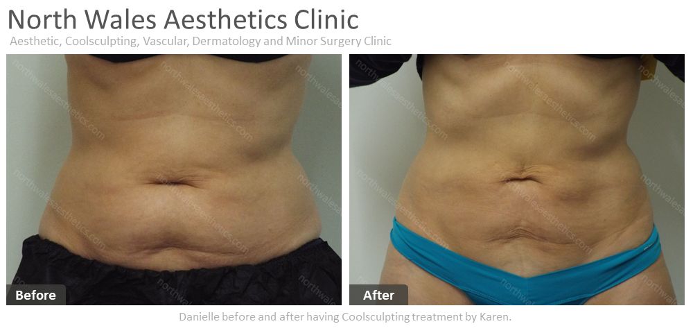 CoolSculpting :: North Wales Aesthetics