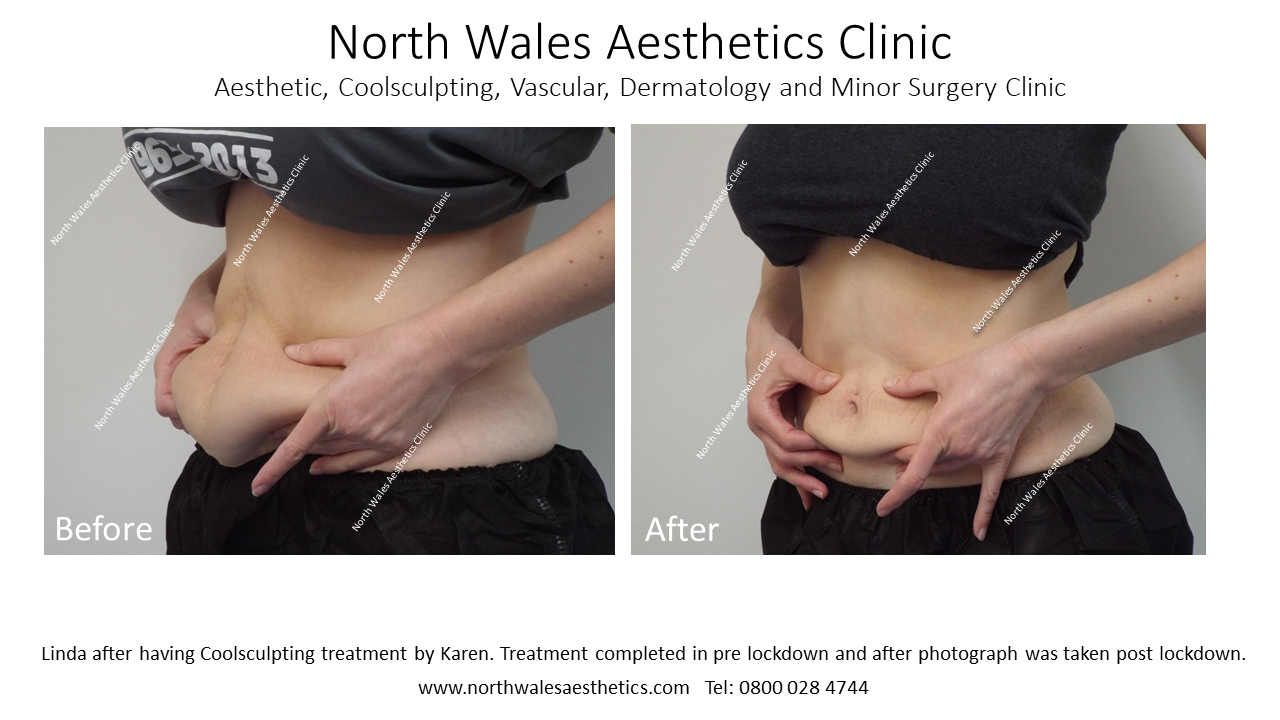 CoolSculpting :: North Wales Aesthetics