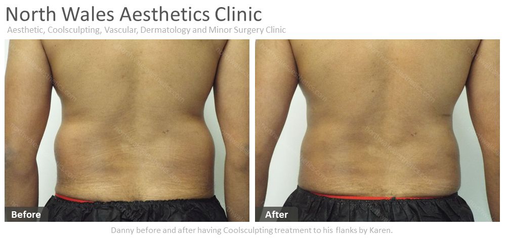 CoolSculpting Flanks (Love Handles) Before & After Photos - Cosmetic -  Ark-La-Tex Dermatology & Medical Spa - Louisiana - A Part of the  Willis-Knighton Physician Network