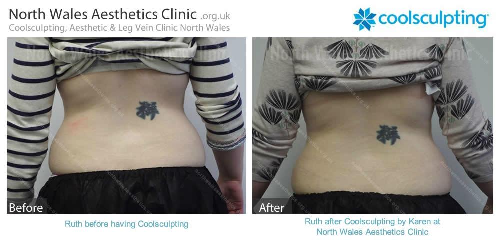 CoolSculpting :: North Wales Aesthetics