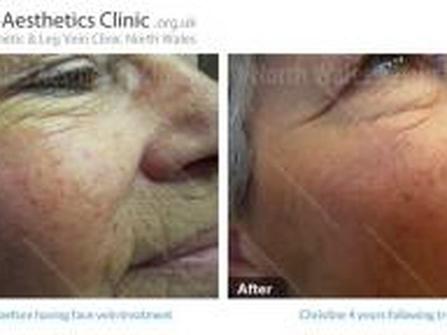 Permanent removal of facial veins