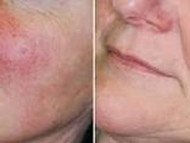 Permanent removal of facial veins