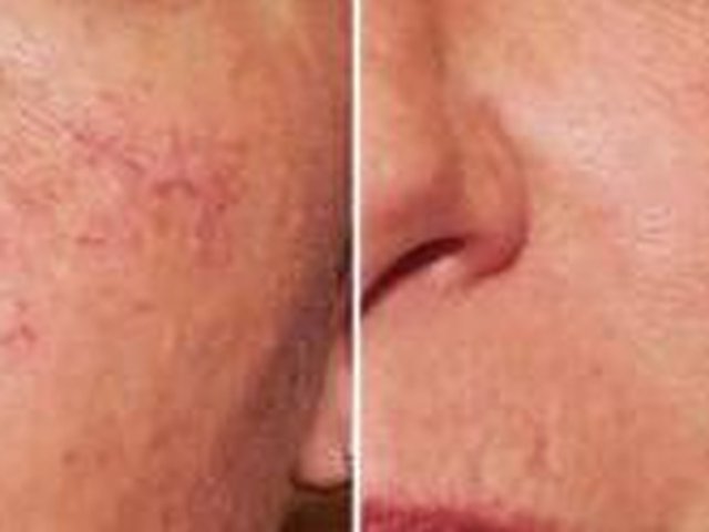Permanent removal of facial veins