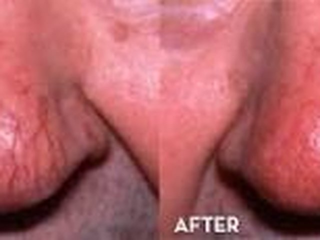 Permanent removal of facial veins