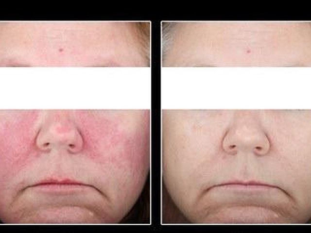 Rosacea And Facial Flushing