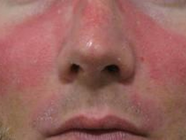 Rosacea And Facial Flushing