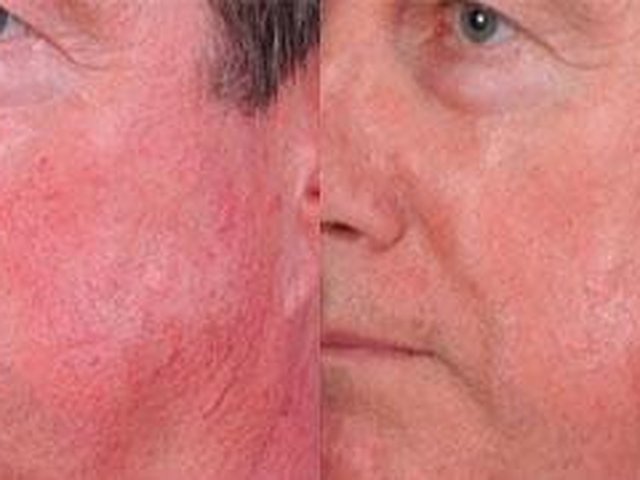 Rosacea And Facial Flushing