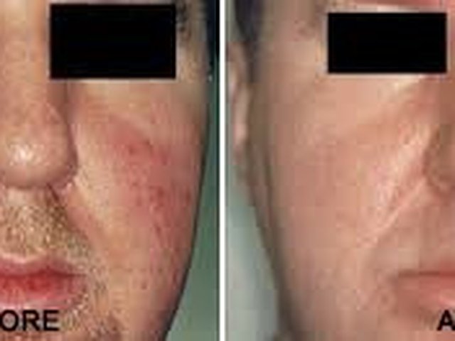 Rosacea And Facial Flushing