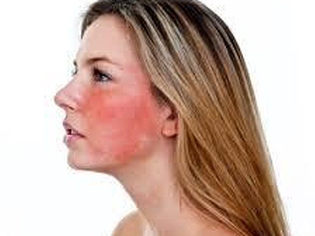 Rosacea And Facial Flushing