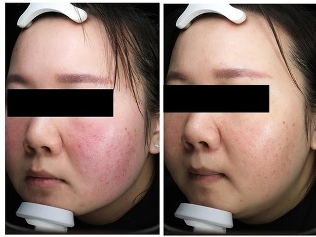 treatment before and after 1