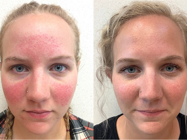 treatment before and after 3