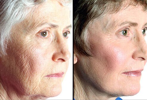 Should you consider a facelift?