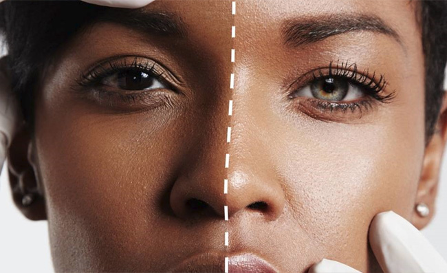 Skin Lightening With Vitamin C And Glutathione Drips North Wales 