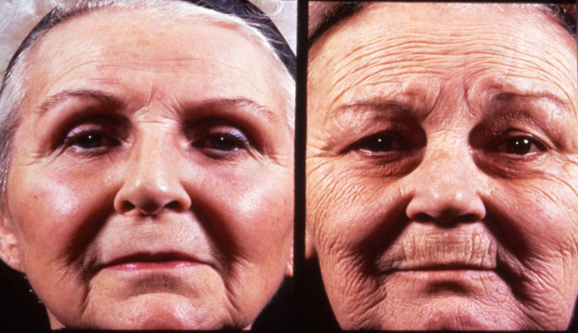 The sun causes rapid ageing and crêpey wrinkly skin