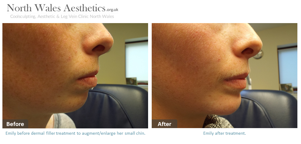 Unhappy with a small receding chin and weak jawline? :: North Wales  Aesthetics